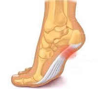 Do I Have Plantar Fasciitis?