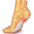 Do I Have Plantar Fasciitis?